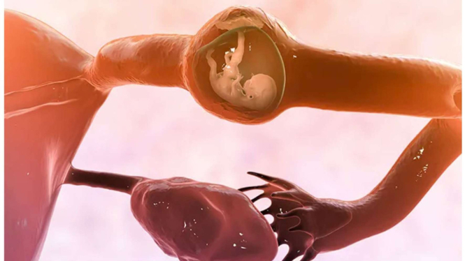 Fetus in Fetu