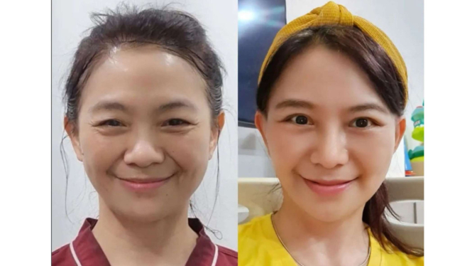 Before-After Puspa Dewi operasi plastik anti aging