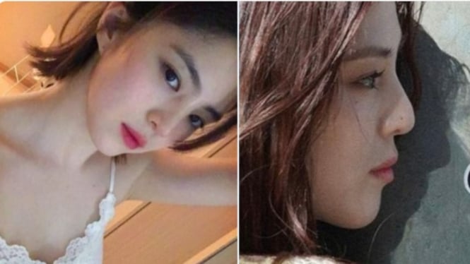 Penampilan hidung Han So Hee sebelum dan sesudah operasi plastik
