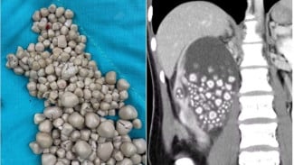 Dokter Temukan 300 Batu Ginjal Dalam Perut Seorang Wanita, Penyebabnya Sering Disepelekan