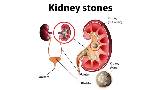 Ilustrasi batu ginjal