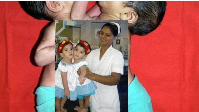 Bocah Kembar Siam Bisa Lepas Setelah Jalani 12 Jam Operasi