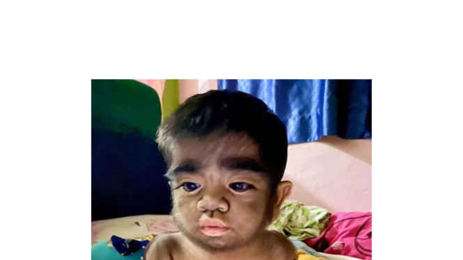 Bayi Berbulu Sindrome Srigala