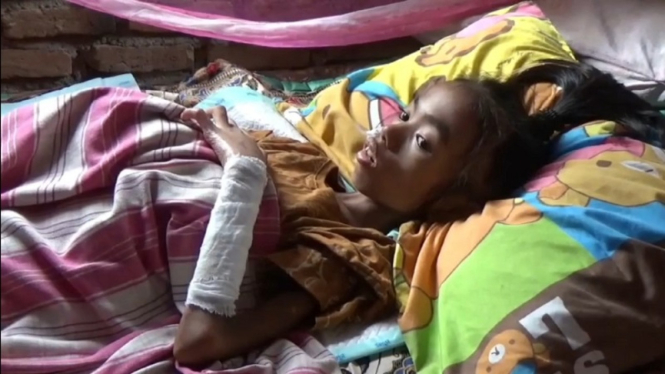 Adelia Rahma, bocah SD di Pariaman alami luka bakar dan gizi buruk