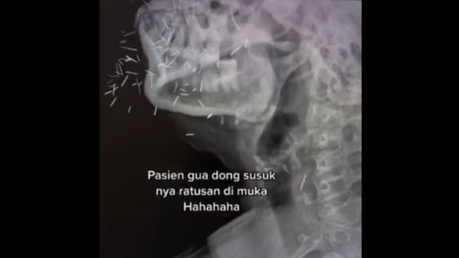 Hasil CT Scan ungkap ratusan susuk di wajah pasien.