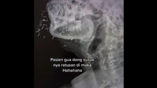 Hasil CT Scan ungkap ratusan susuk di wajah pasien.