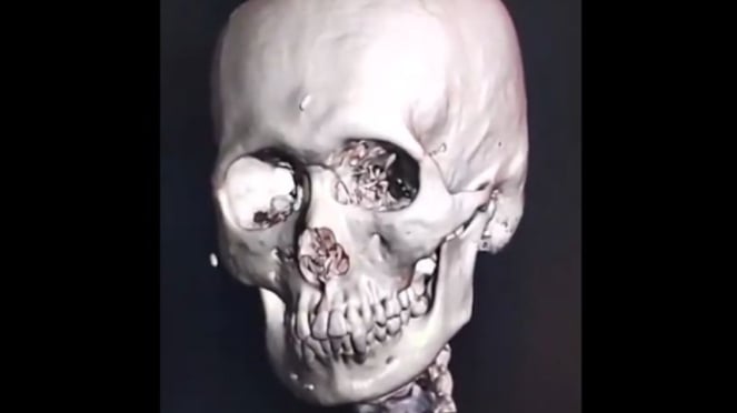 Hasil CT Scan ungkap ratusan susuk di wajah pasien.
