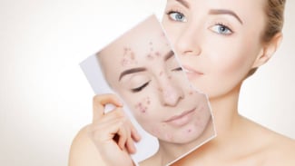 Gak Usah Insecure Sama Bopeng dan Stretch Marks, Sekarang Ada Cara Ampuh Mengatasinya!