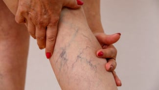 Varises Bisa Sebabkan Pembengkakan Hingga Kram Kaki, Dokter Ungkap Cara Efektif Menghilangkannya