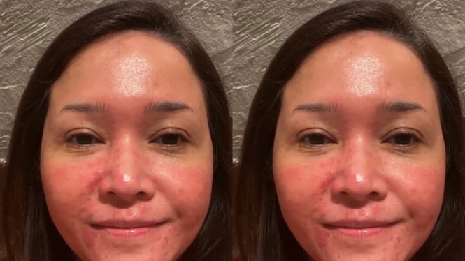 Maia Estianty menderita rosacea.