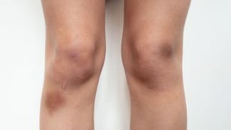 Jangan Anggap Remeh! Atasi Cedera dengan Cepat dan Tepat agar Tidak Menimbulkan Risiko Buruk Lainnya