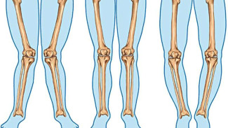 Jangan Sepelekan, Ini Komplikasi Kelainan Kaki O dan X Pada Anak Jika Tidak Ditangani